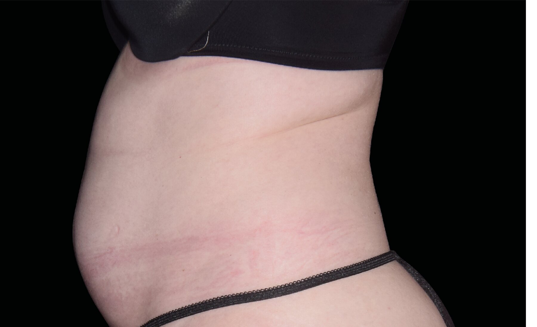 Before Emsculpt Neo treatment showing abdominal fullness in side profile.