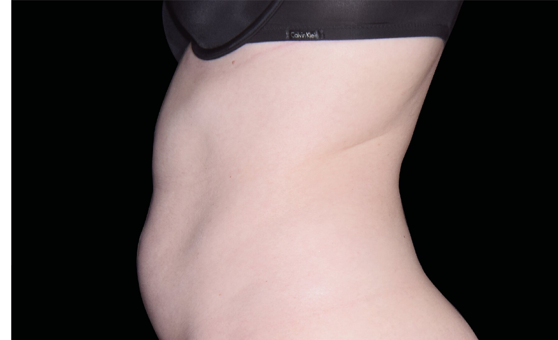 After Emsculpt Neo treatment showing a flatter abdomen and improved contour.