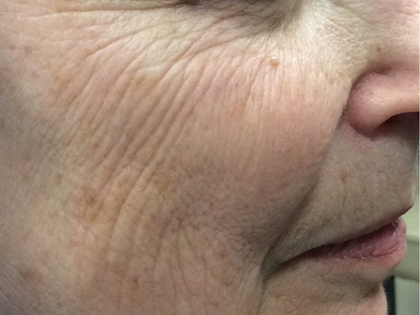 Representative laser result showing smoother texture around the cheek.