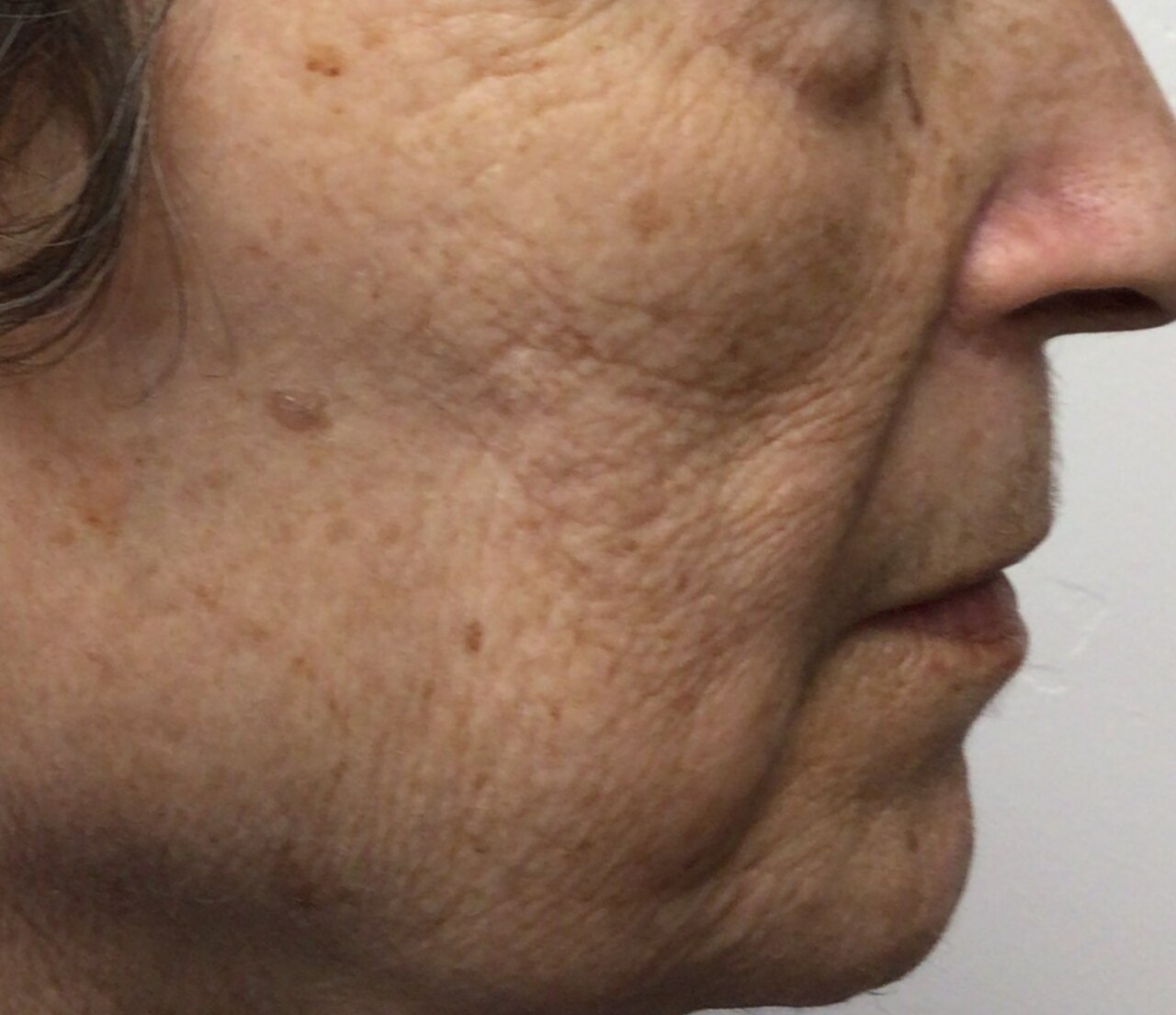 Before Lumecca IPL treatment showing texture and sun-damage concerns on the cheek.