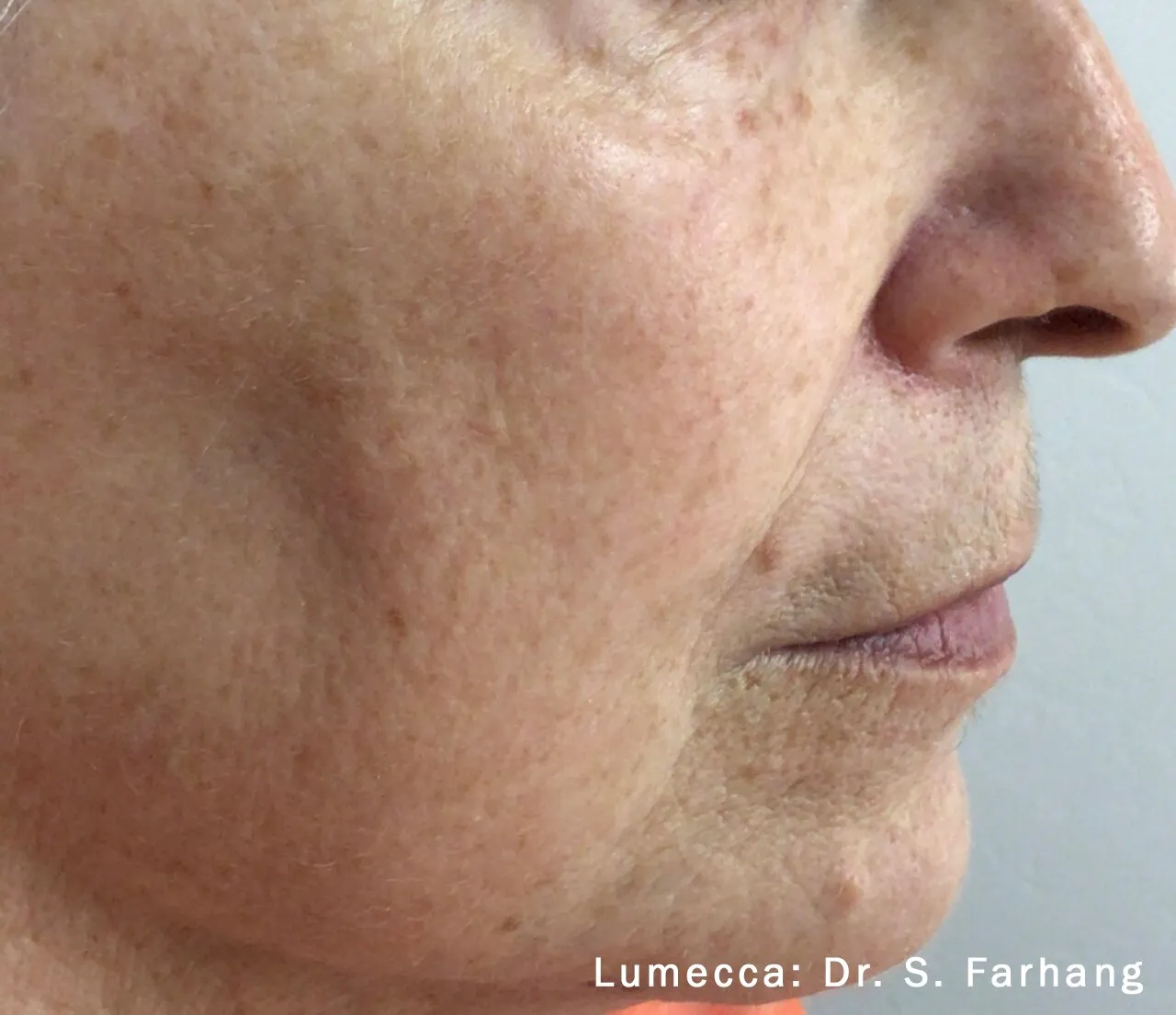 After Lumecca IPL treatment showing smoother texture and more even skin tone on the cheek.