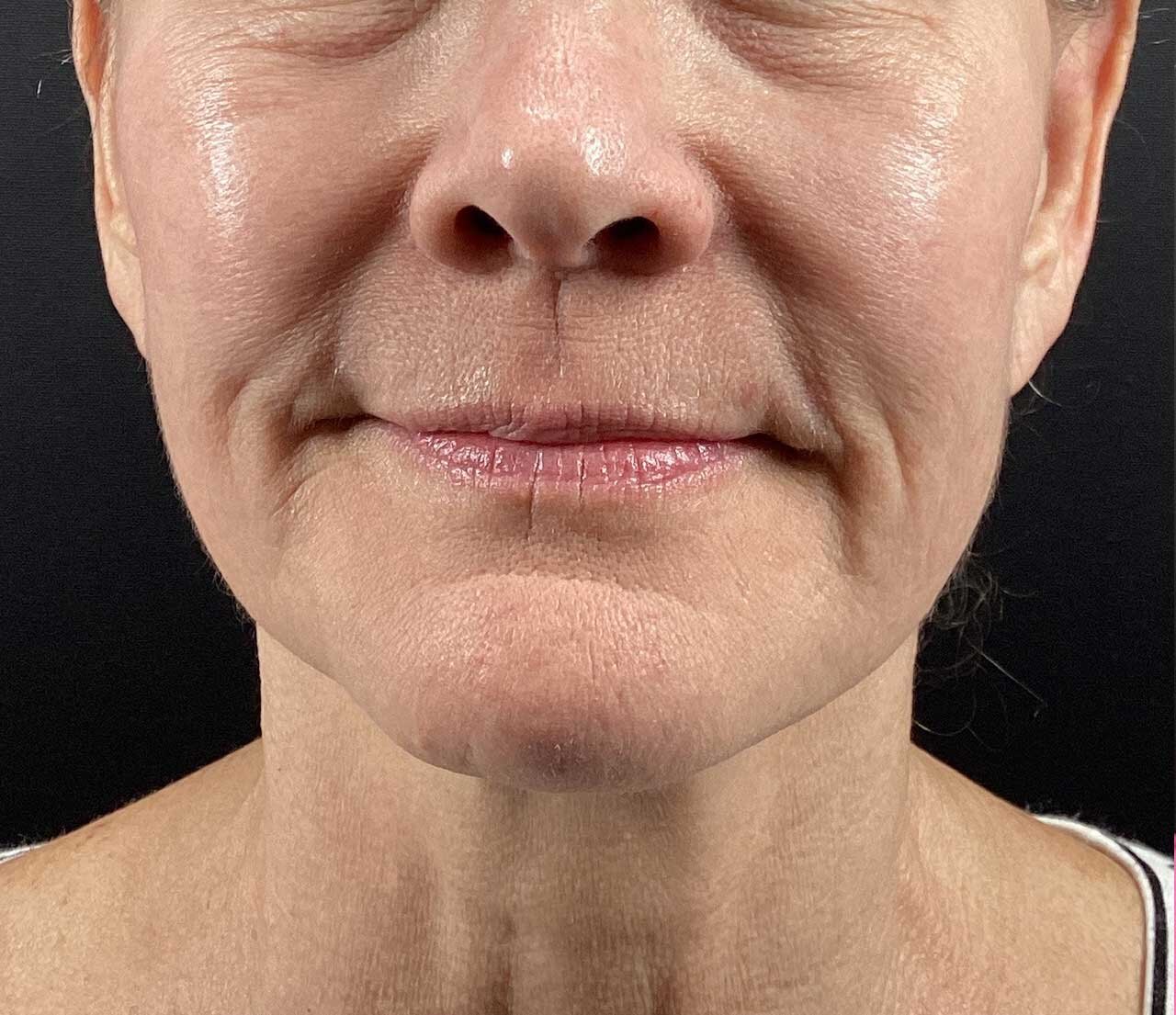Before Morpheus8 treatment showing lower-face laxity and texture concerns.