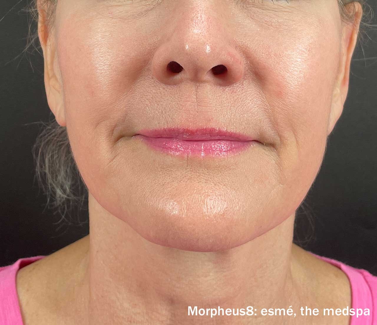 After Morpheus8 treatment showing smoother texture and firmer lower-face contour.