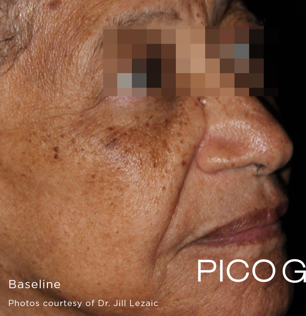 Before Pico Genesis treatment showing visible dark spots and uneven pigmentation.