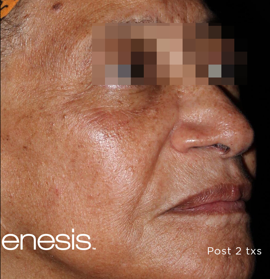 After Pico Genesis treatment showing softer pigmentation and clearer skin tone.