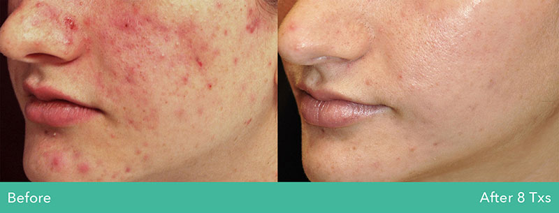 Acne scarring before and after Secret RF microneedling treatment Acne scarring before and after Secret RF microneedling treatment