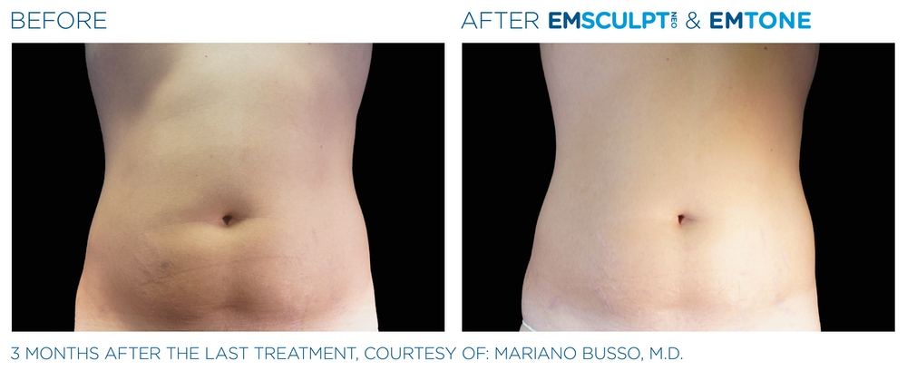 truSculpt fleX vs EMSculpt NEO at Miami Skin Spa in Brickell