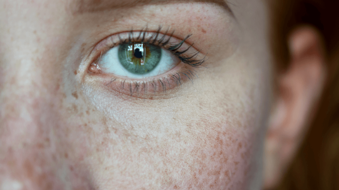 Causes and Treatments For Skin Discoloration at Miami Skin Spa in Brickell