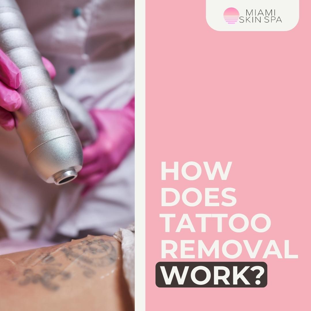 How Does Tattoo Removal Work? at Miami Skin Spa in Brickell