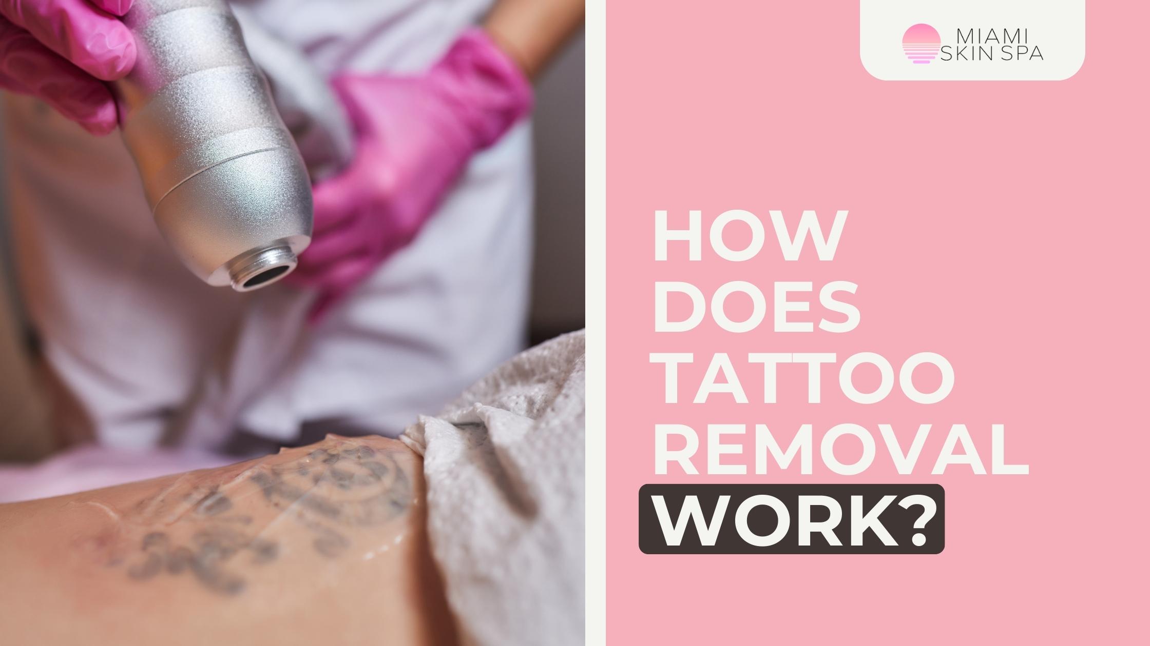 How Does Tattoo Removal Work?