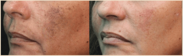 Pico Genesis brown spot removal before and after results