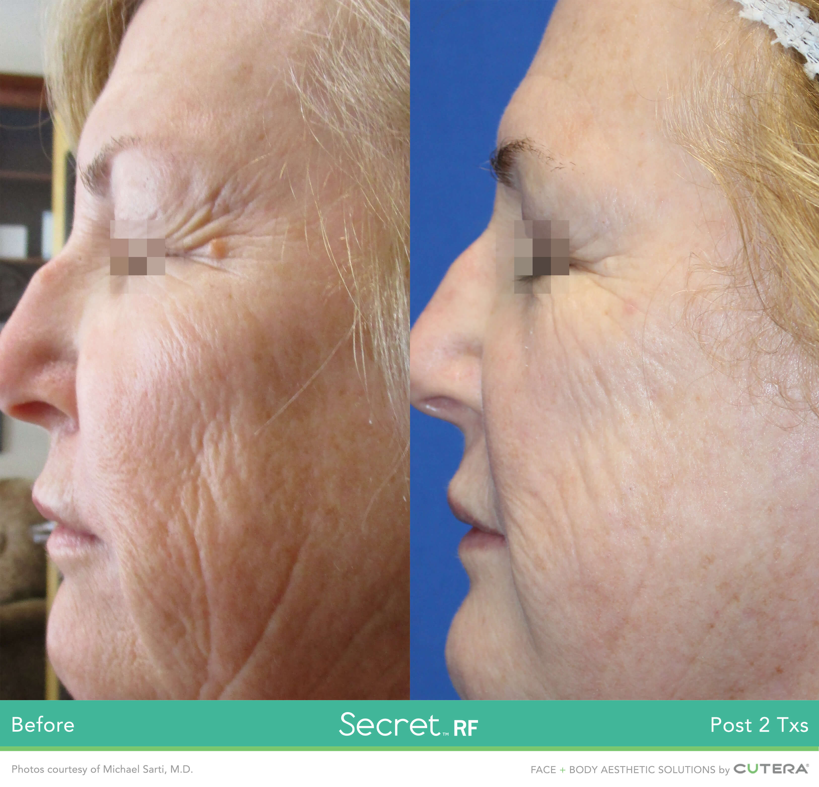 Deep wrinkle treatment before and after with RF microneedling