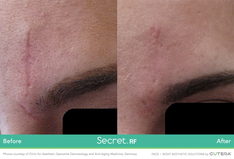 Scar removal before and after with Secret RF microneedling