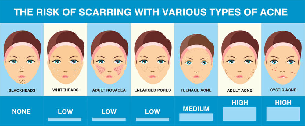 The risk of scarring with various types of acne from blackheads to cystic acne