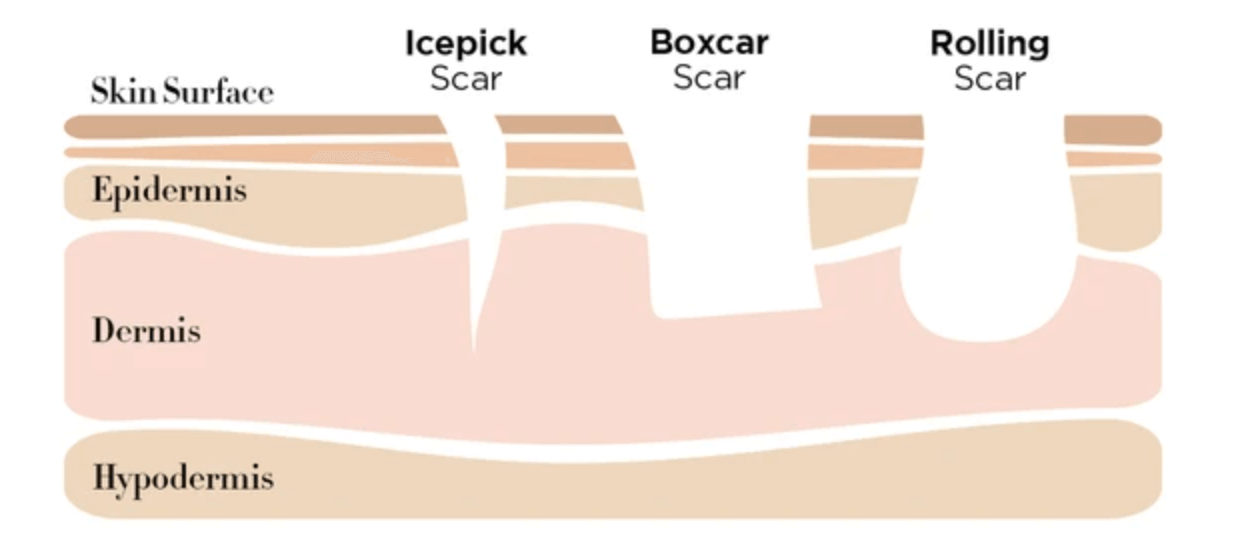 Atrophic acne scar cross-section diagram showing icepick, boxcar, and rolling scars at different skin depths
