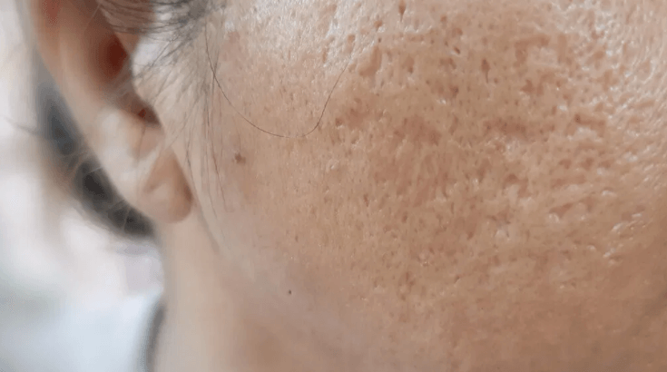 Close-up clinical photo of boxcar acne scars showing wide, pitted depressions