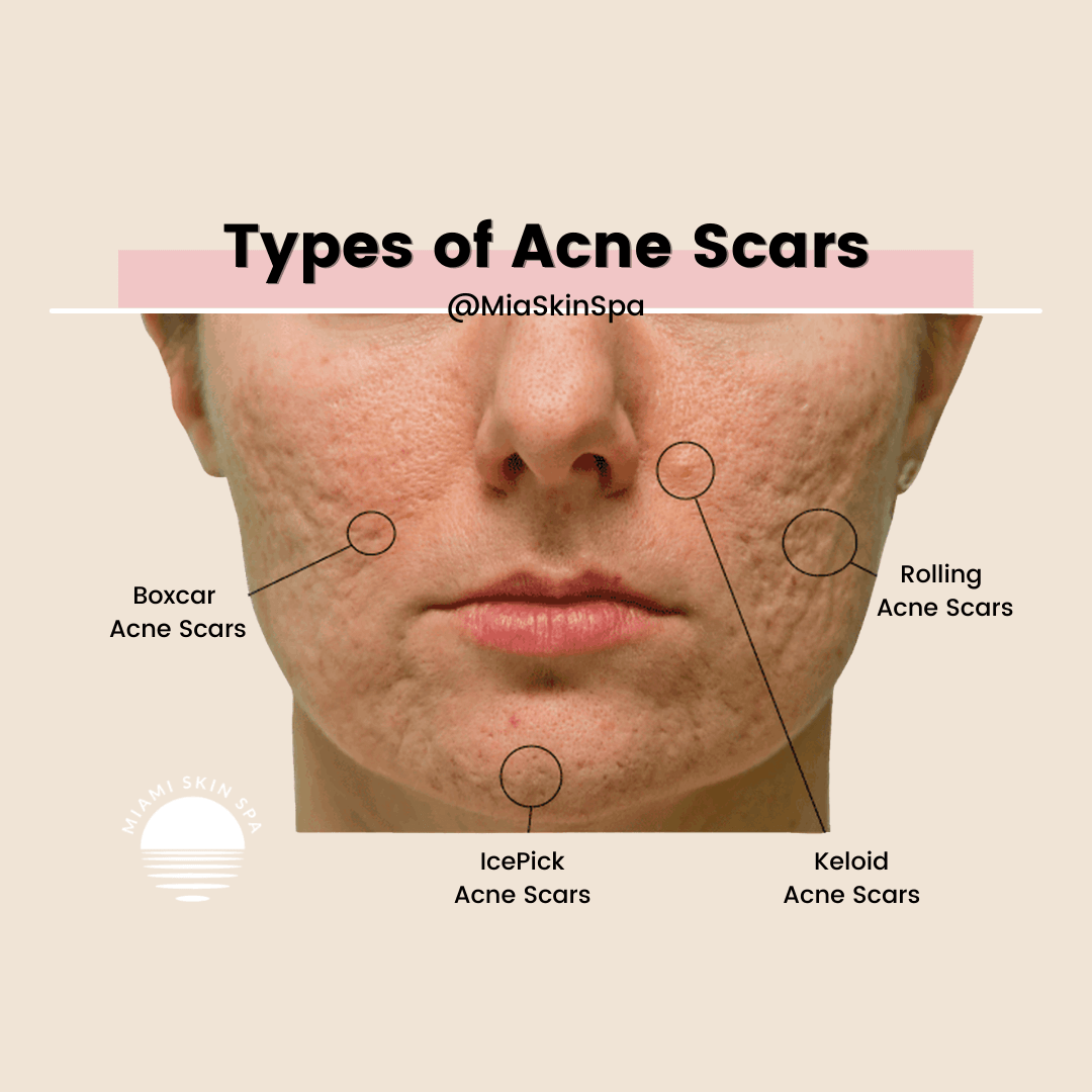 Types of acne scars mapped on a face showing where boxcar, rolling, icepick, and keloid scars typically appear