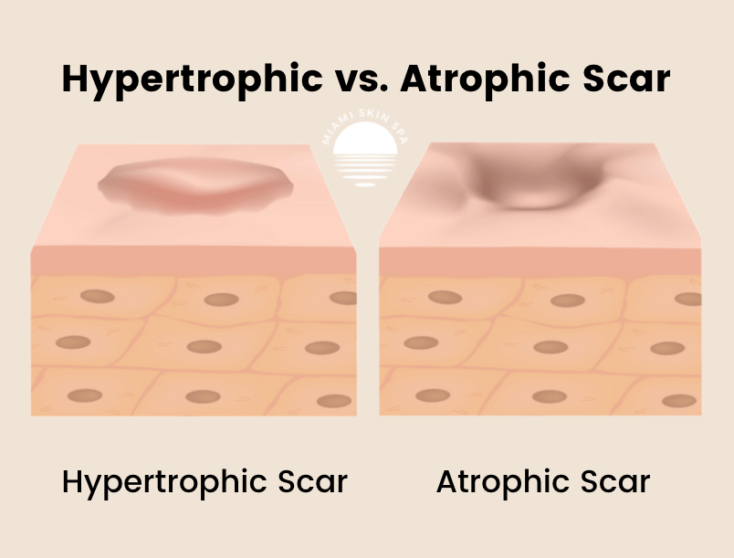 Hypertrophic vs atrophic scar comparison showing 3D skin cross-sections
