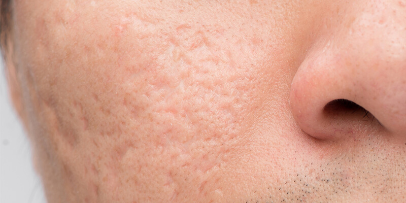 Close-up clinical photo of icepick acne scars showing deep, narrow pits in the skin