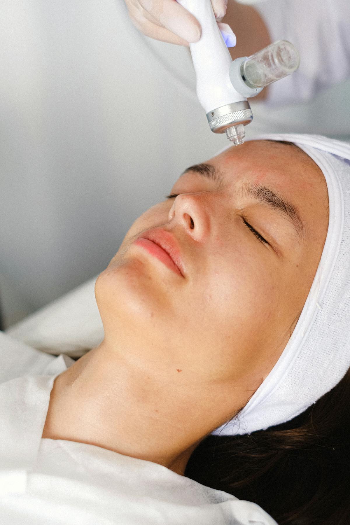 Microneedling treatment for acne scar removal at Miami Skin Spa