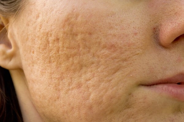 Close-up clinical photo of rolling acne scars on a cheek