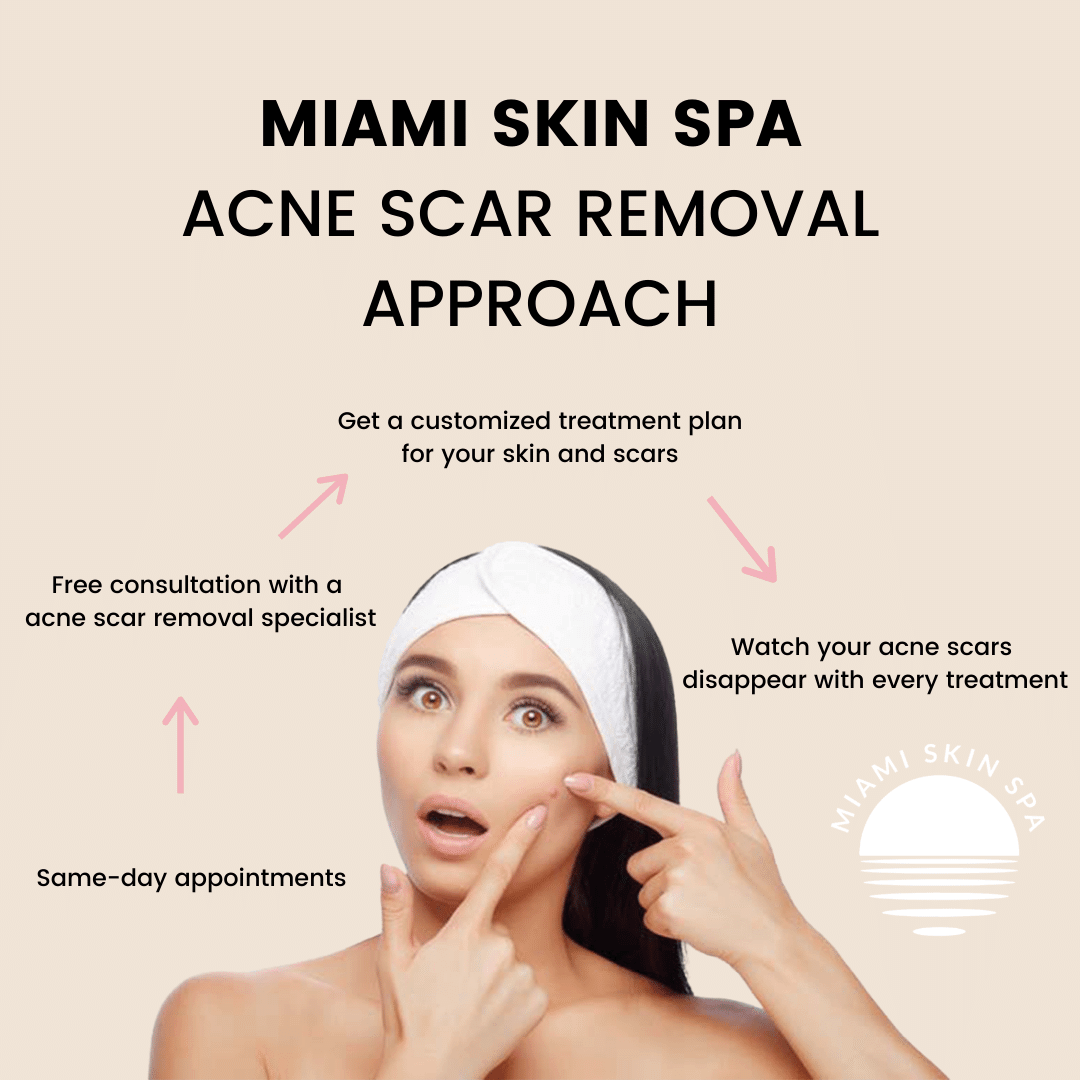Miami Skin Spa acne scar removal approach — consultation, treatment plan, and results