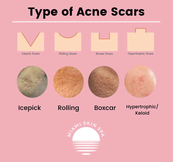 Type of Acne Scars — icepick, rolling, boxcar, and hypertrophic with cross-sections and clinical photos