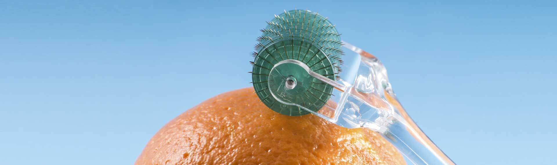 How Long Does Microneedling Last?