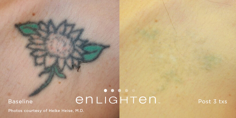 Tattoo removal before and after with Enlighten laser Tattoo removal before and after with Enlighten laser