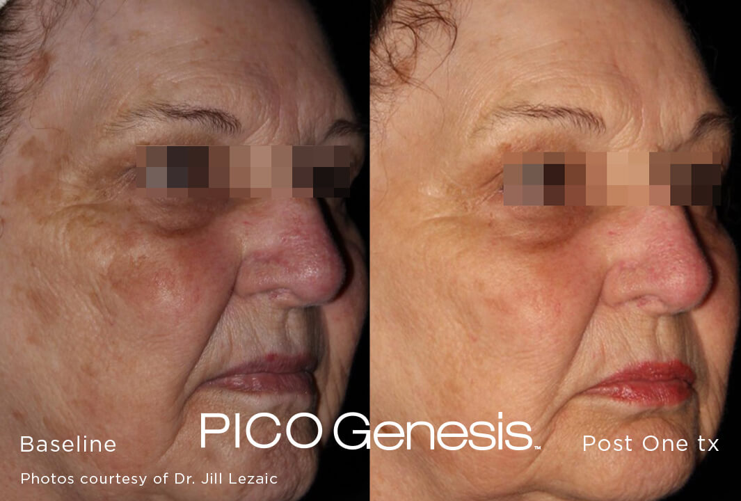 Pico Genesis laser dark spot treatment before and after Pico Genesis laser dark spot treatment before and after