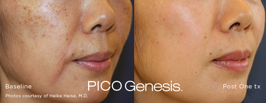 Pico Genesis sun damage treatment before and after