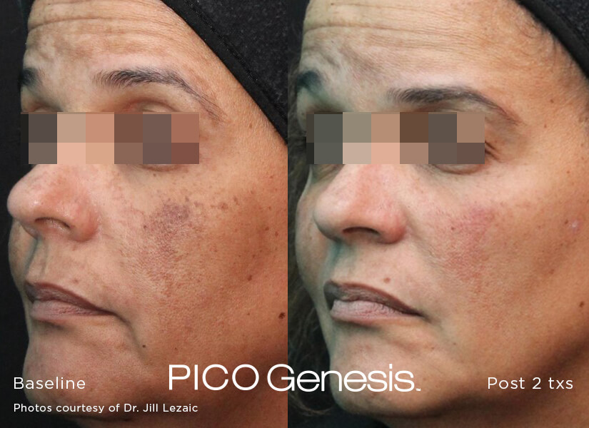 Pico Genesis hyperpigmentation treatment before and after