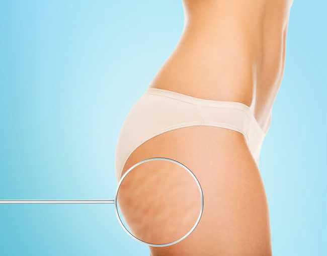 cellulite on leg illustration