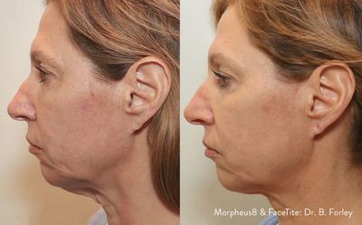Morpheus8 skin tightening before and after results