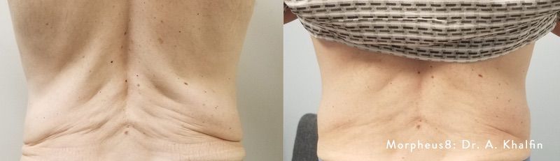 How to Tighten Loose Skin After Weight Loss at Miami Skin Spa in Brickell