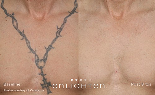 Does Tattoo Removal Leave Scars? at Miami Skin Spa in Brickell