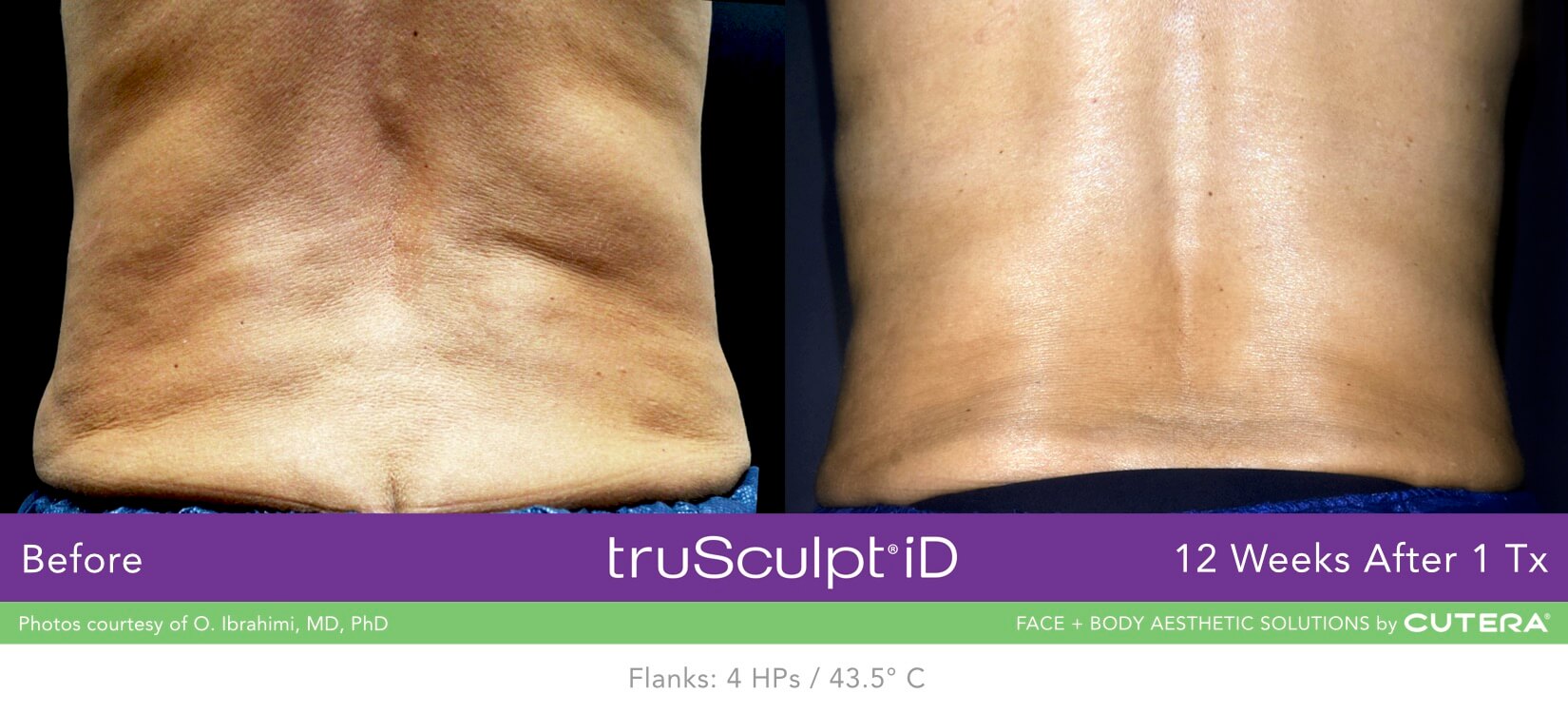 truSculpt iD body contouring before and after results