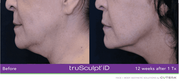 truSculpt iD chin treatment results