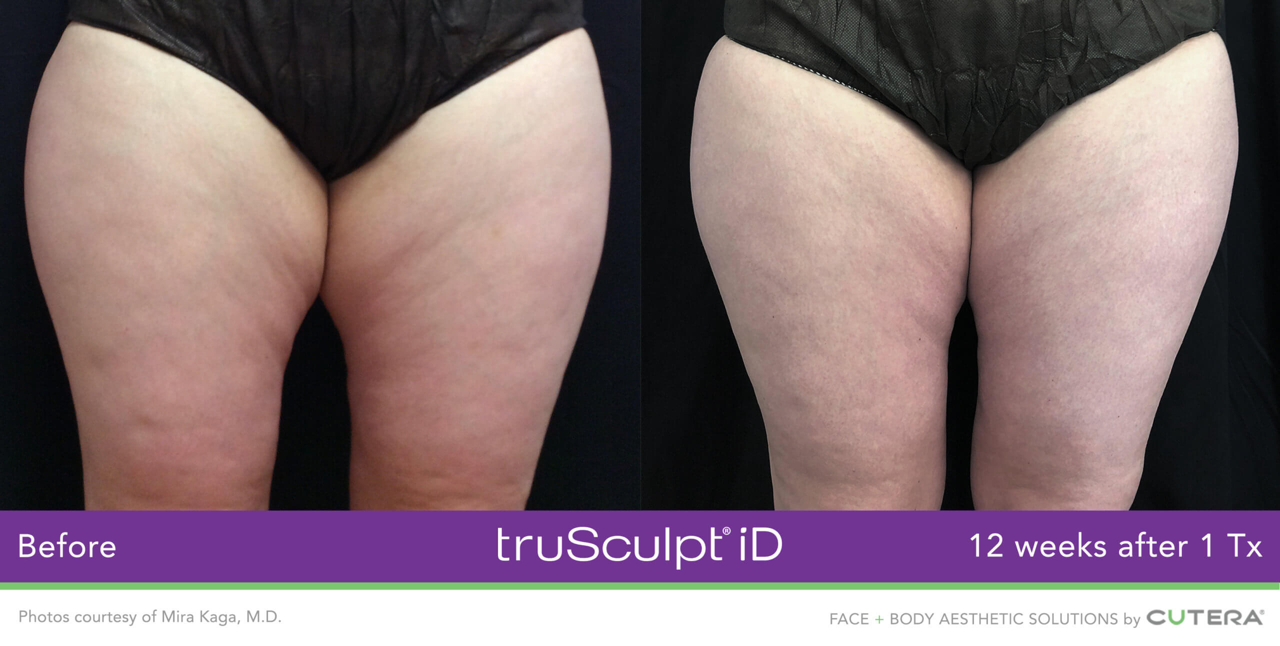 truSculpt iD body contouring before and after — back treatment