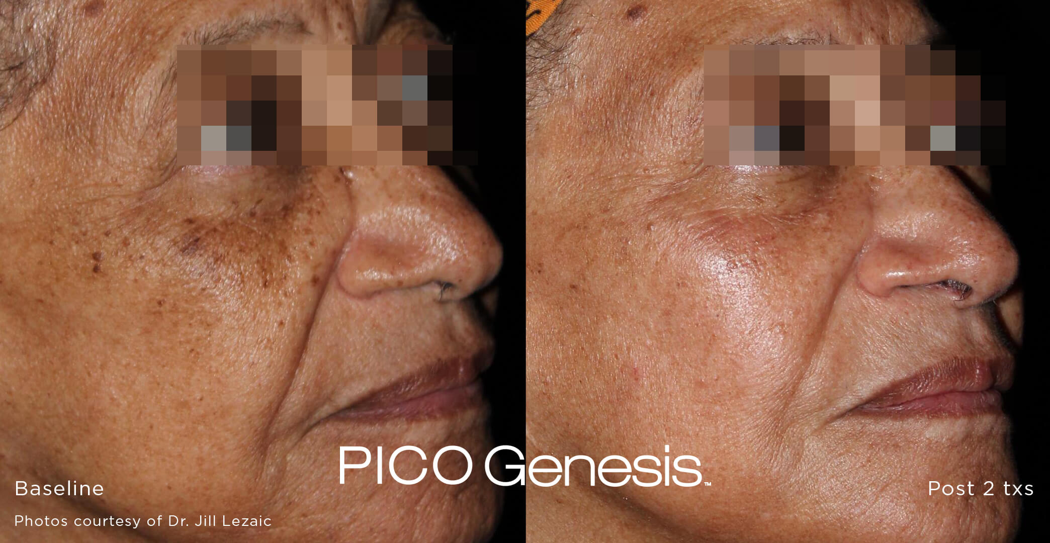 Before-and-after composite: diffuse full-face pigmentation softened after Pico Genesis treatment on a deeper skin tone.