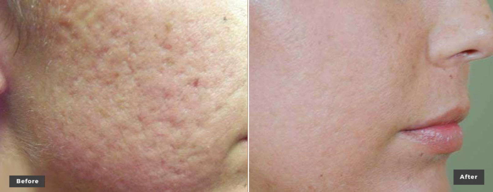 Body laser at Miami Skin Spa in Brickell — before and after skin revitalization