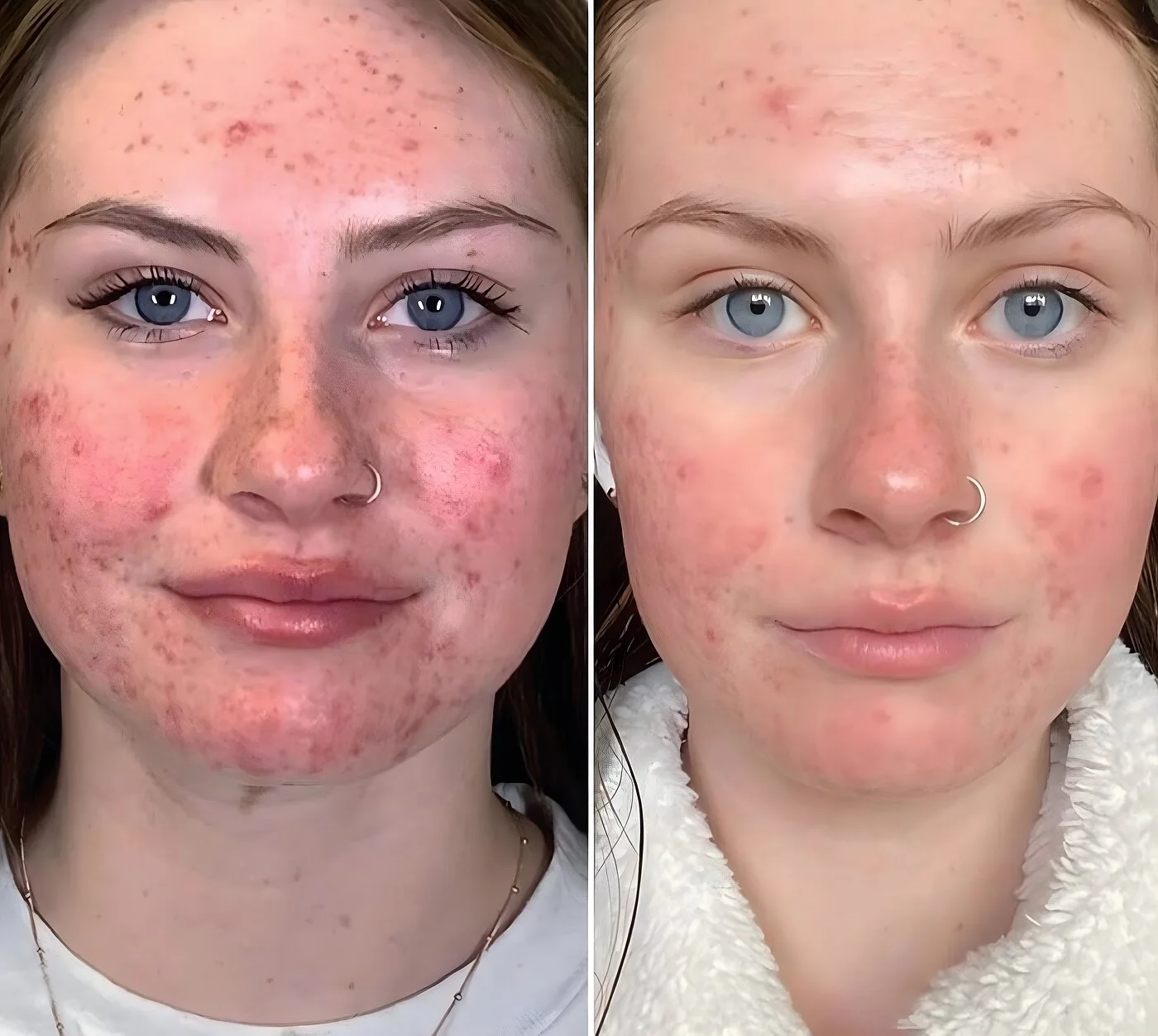Chemical peel before and after — inflamed facial acne and redness cleared to even skin at Miami Skin Spa, Brickell.