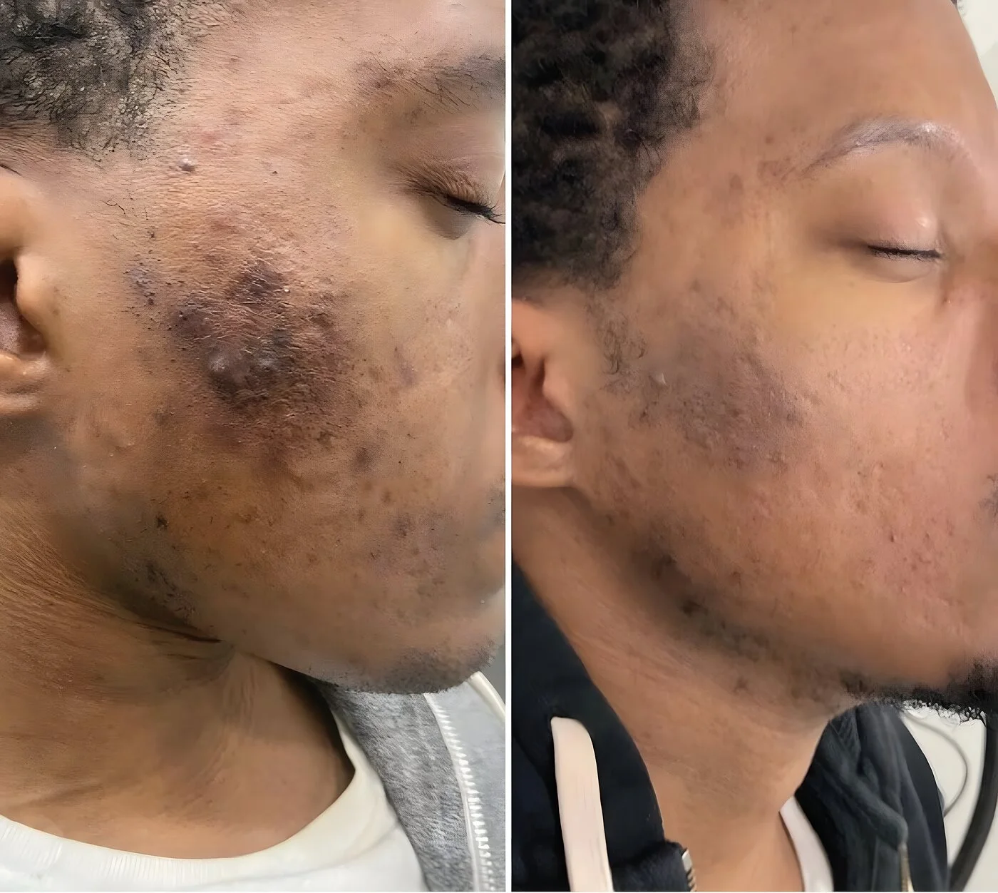 Chemical peel before and after — cheek and jawline acne with post-acne marks cleared at Miami Skin Spa, Brickell.