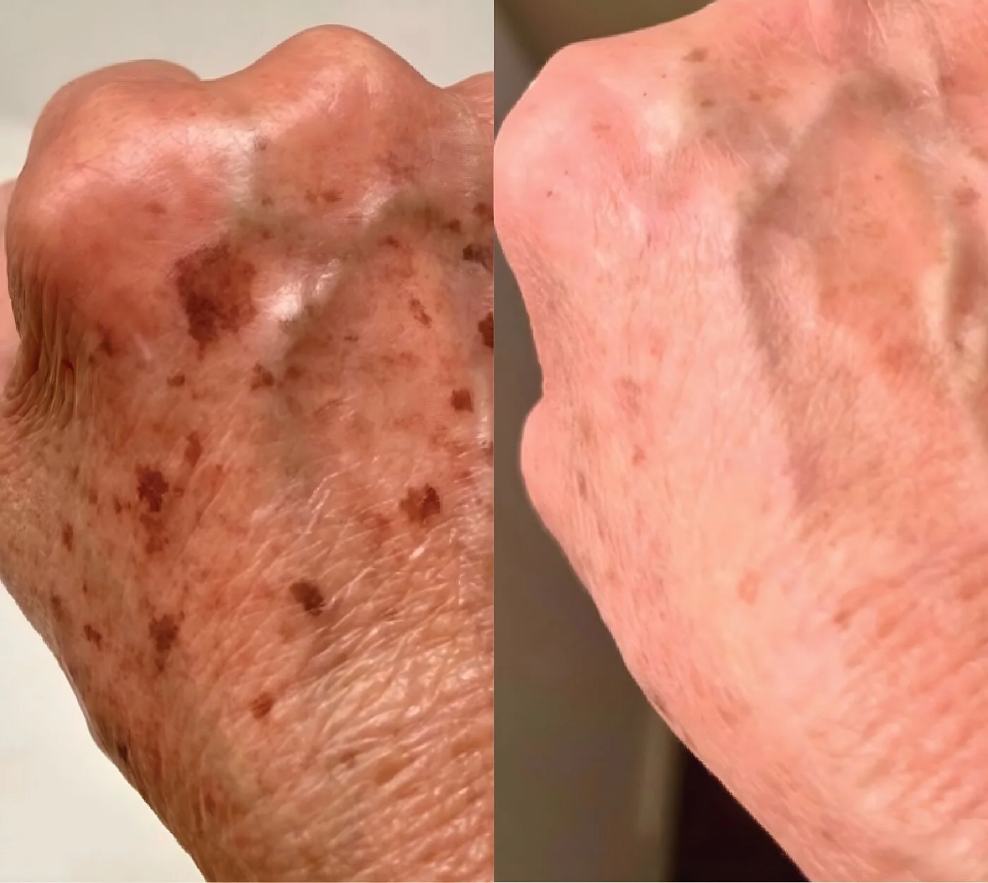 Chemical peel before and after — sun spots on the back of the hand lightened at Miami Skin Spa, Brickell.