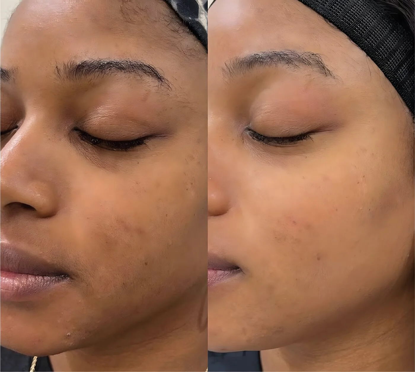 Chemical peel before and after — cheek melasma and uneven tone brightened at Miami Skin Spa, Brickell.