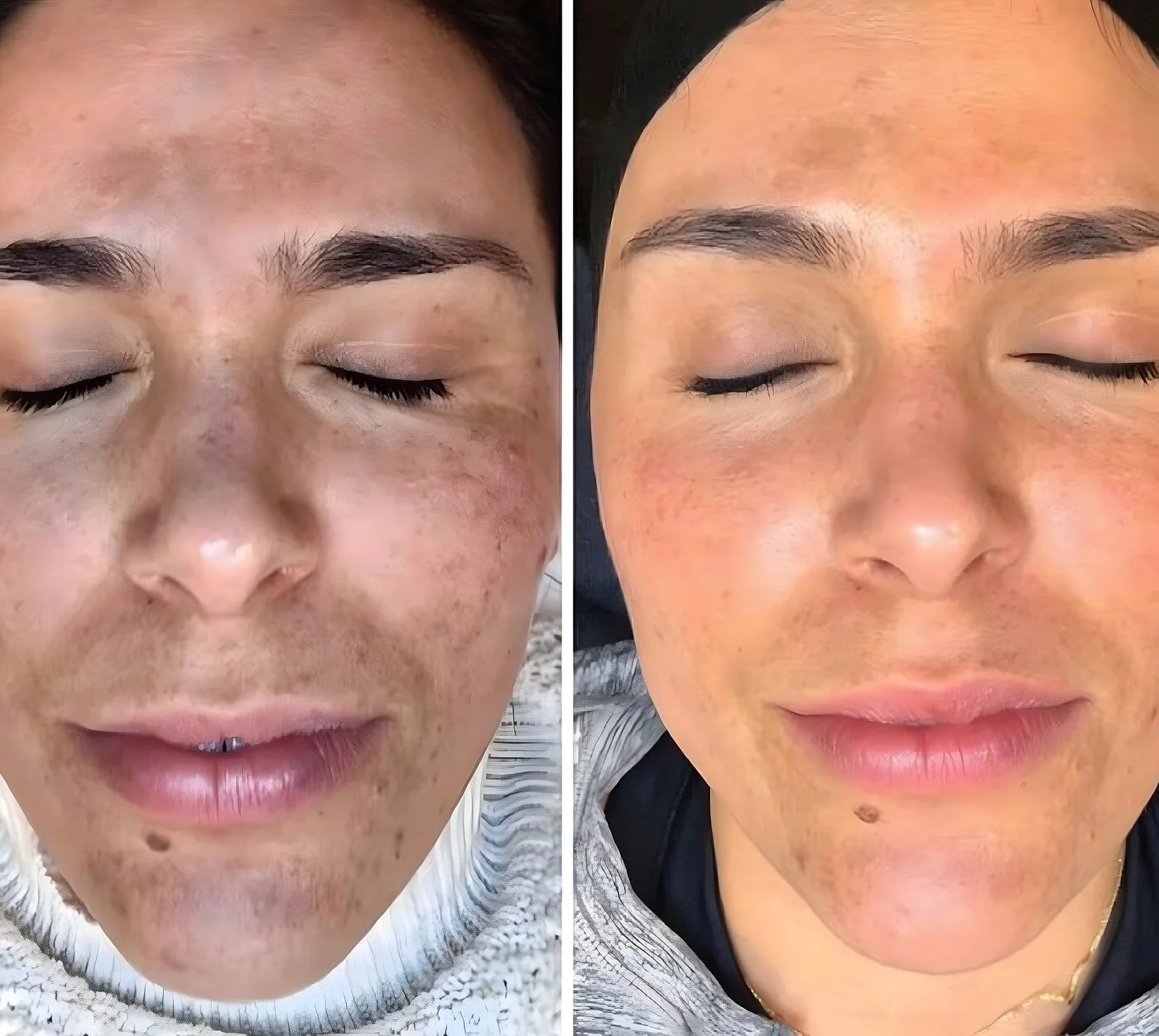Chemical peel before and after — facial sun damage and freckling refined to brighter skin at Miami Skin Spa, Brickell.
