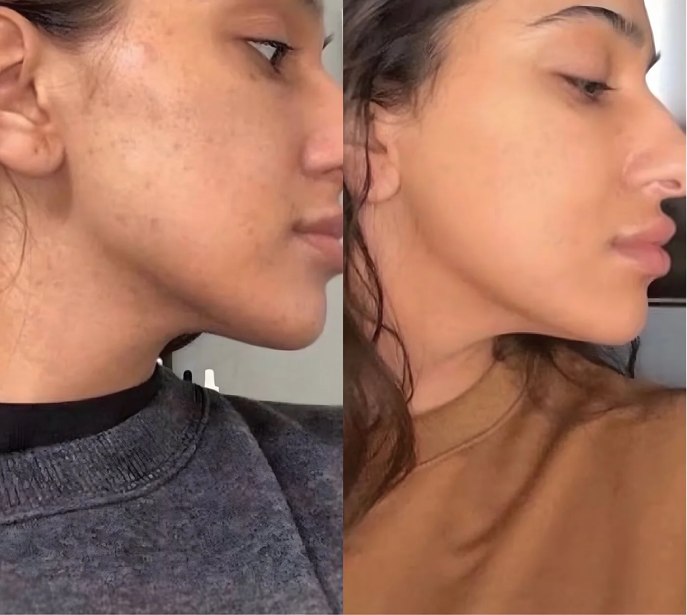 Chemical peel before and after — cheek texture and tone smoothed and brightened in profile at Miami Skin Spa, Brickell.