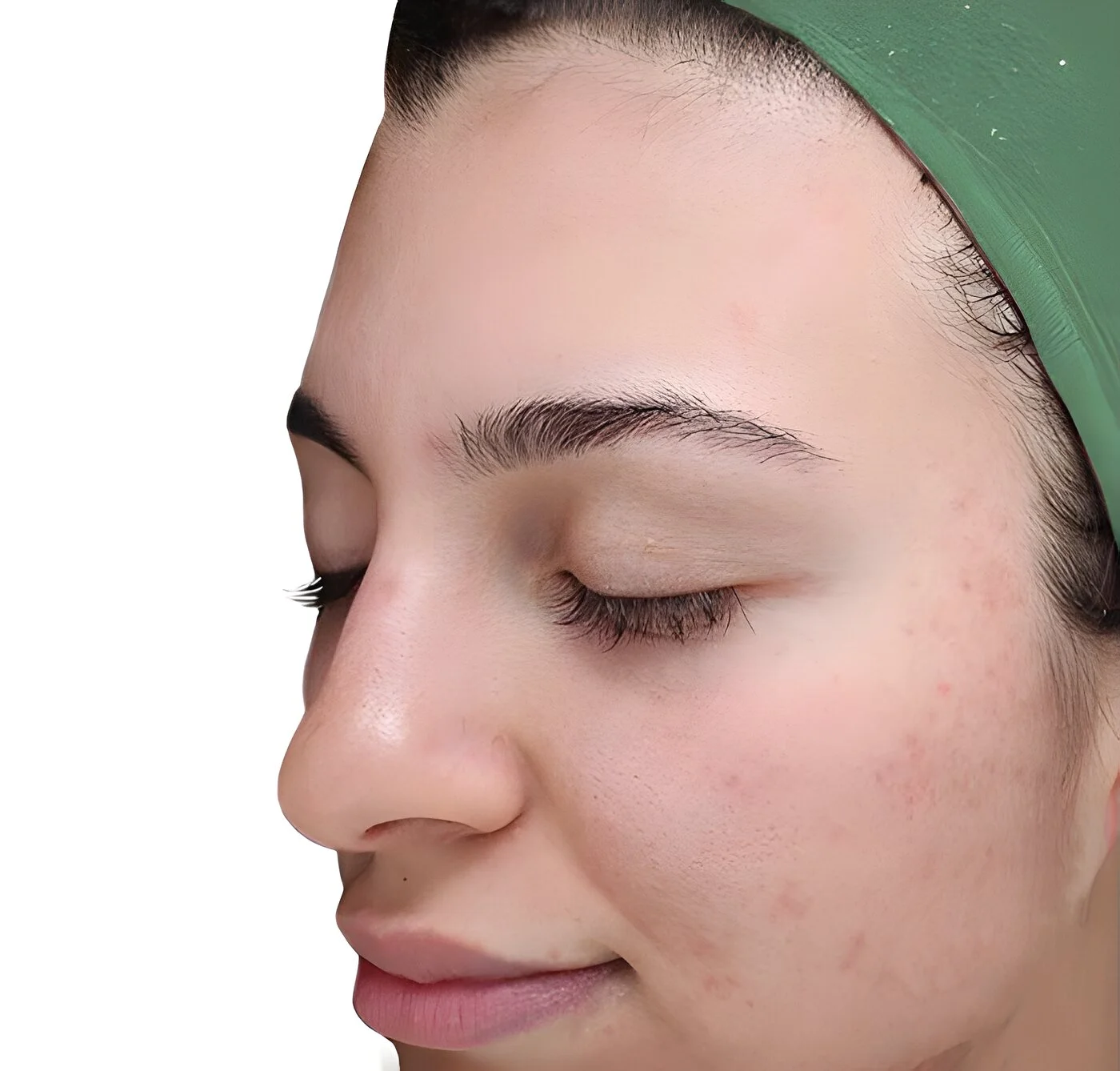 After two VI chemical peels — clear, calm cheek skin at Miami Skin Spa, Brickell.
