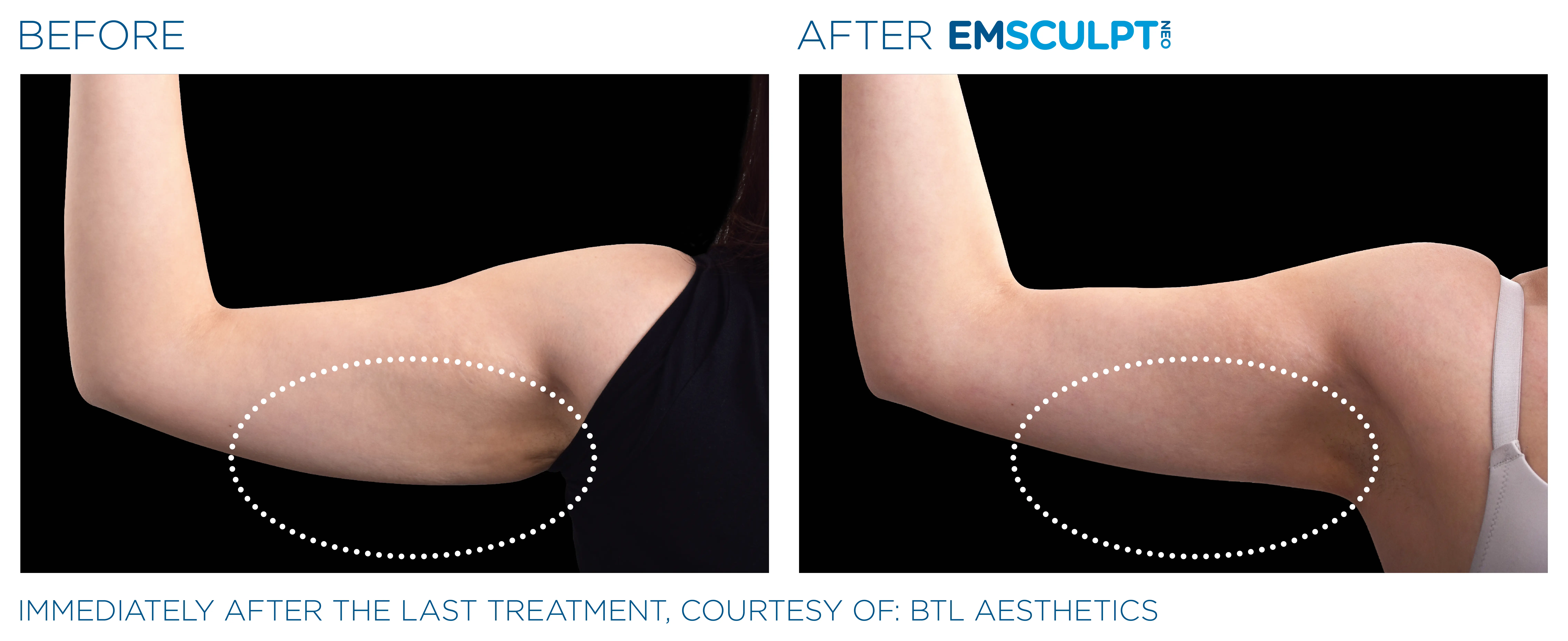 Emsculpt Neo before and after arm result showing improved definition.