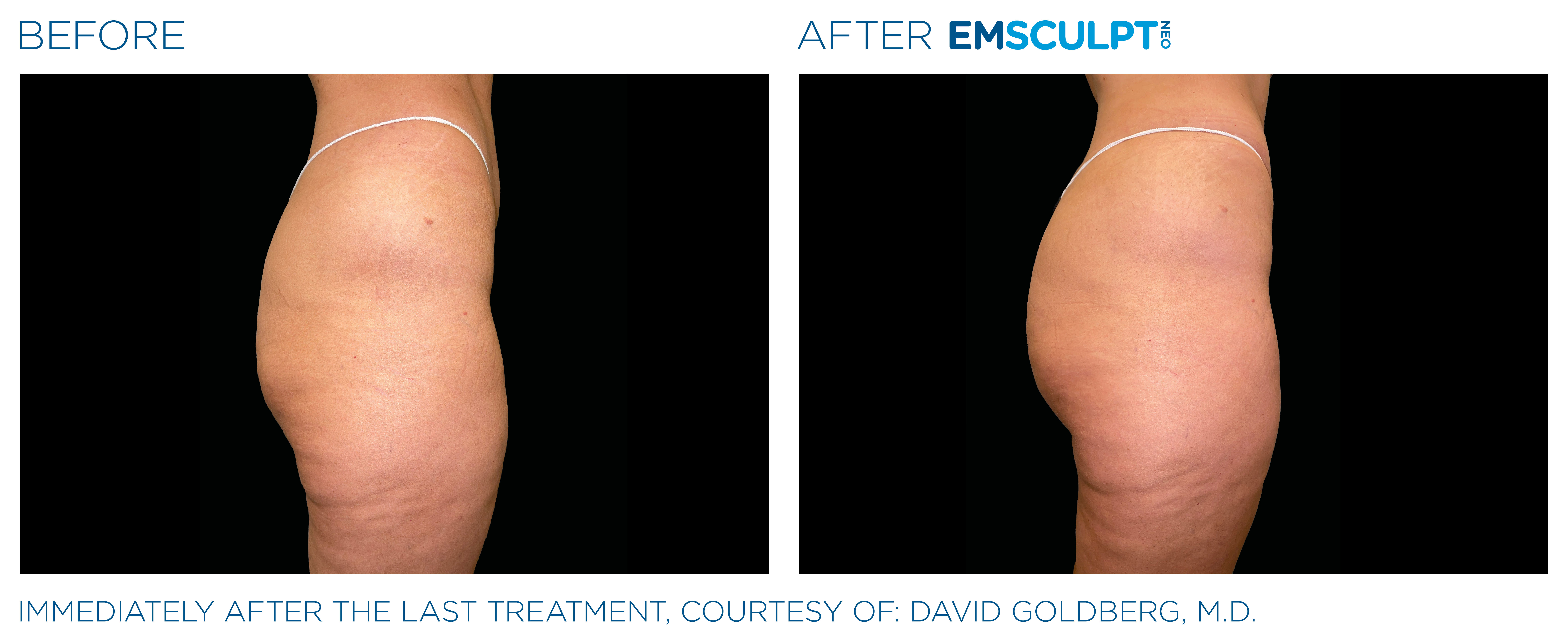 Emsculpt Neo buttock before and after